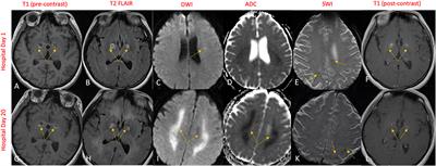 Case report: Bilateral globus pallidus lesions and delayed progressive leukoencephalopathy in COVID-19: Effects of hypoxia alone or combination of hypoxia and inflammation?